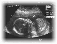 Lily ultrasound